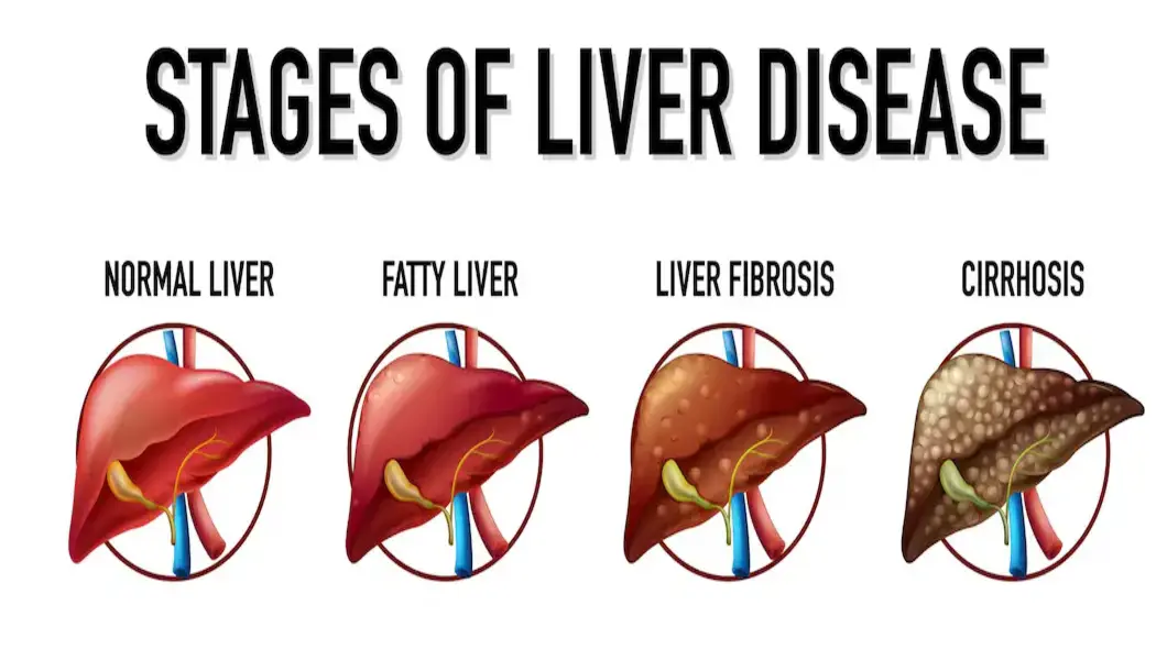 stages of liver disease