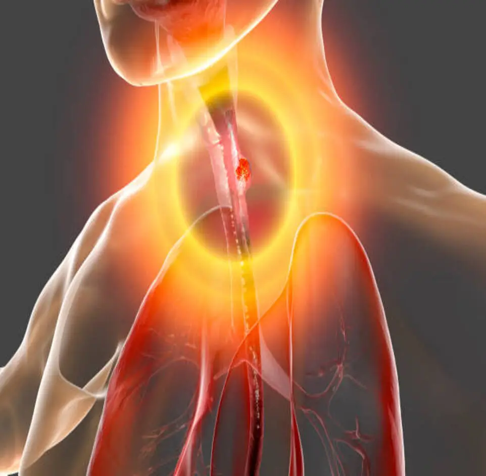 Esophagus Disease - gastro1.in