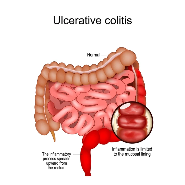 Ulcerative Colitis Gastro1 In