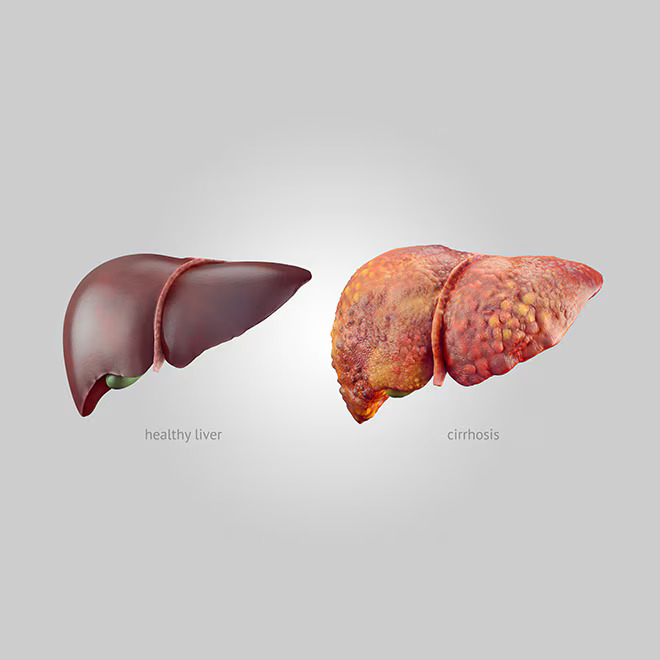 Understanding Liver Cirrhosis