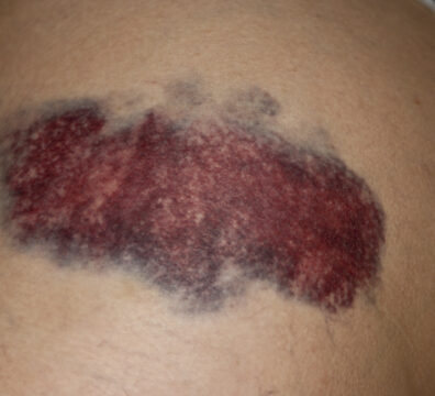 Tendency to bleed and suffer from bruises