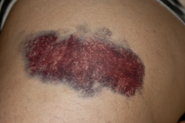Tendency to bleed and suffer from bruises