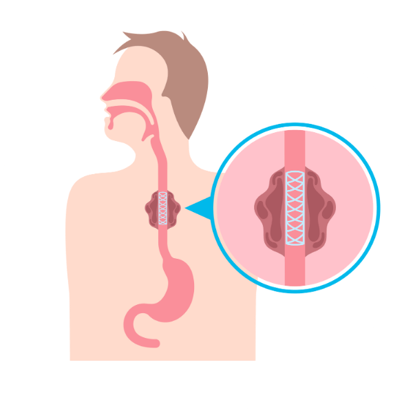 Achalasia