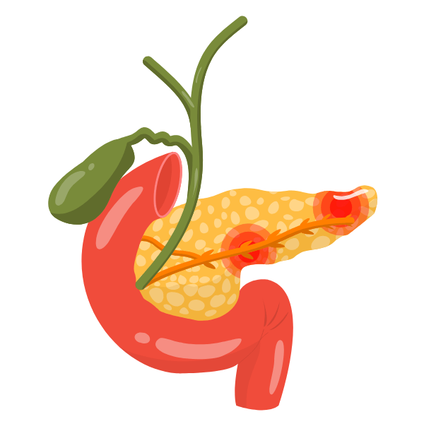 Chronic Pancreatitis