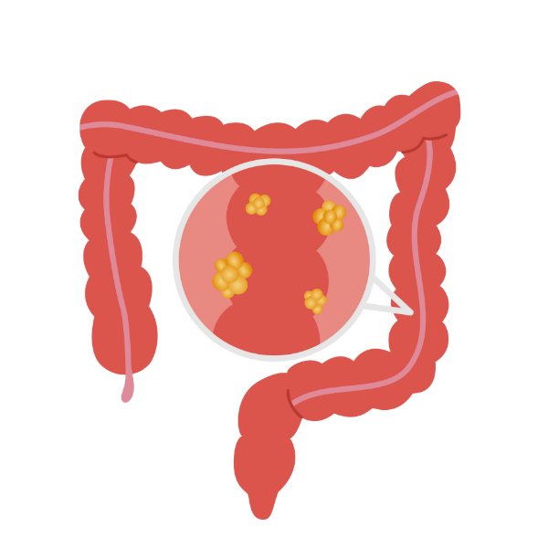 Colon Cancer