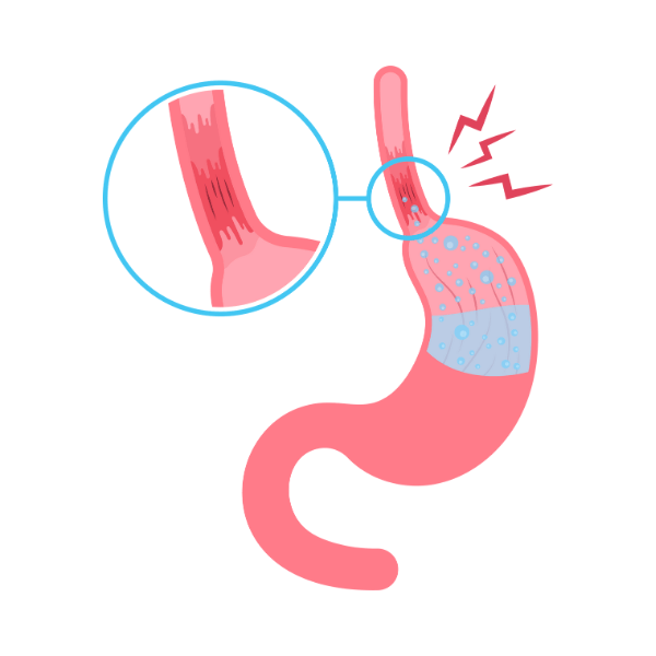 Esophageal Cancer