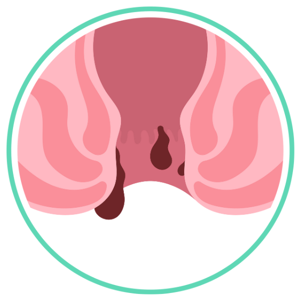 Fistula