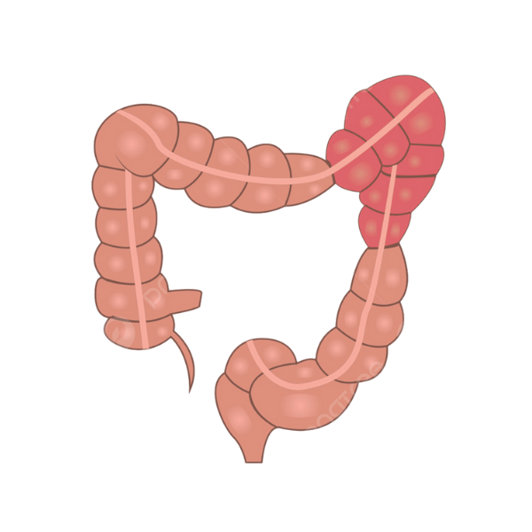Irritable Bowel Syndrome