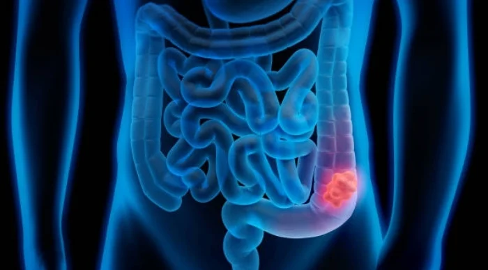 Colon Cancer