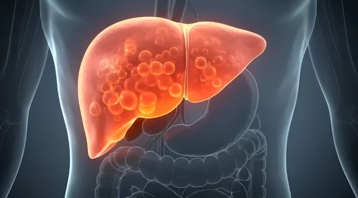 Fatty Liver