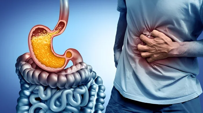 GERD and Chronic Acidity