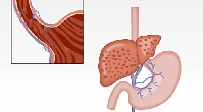 GI Bleeding and Esophageal Varices