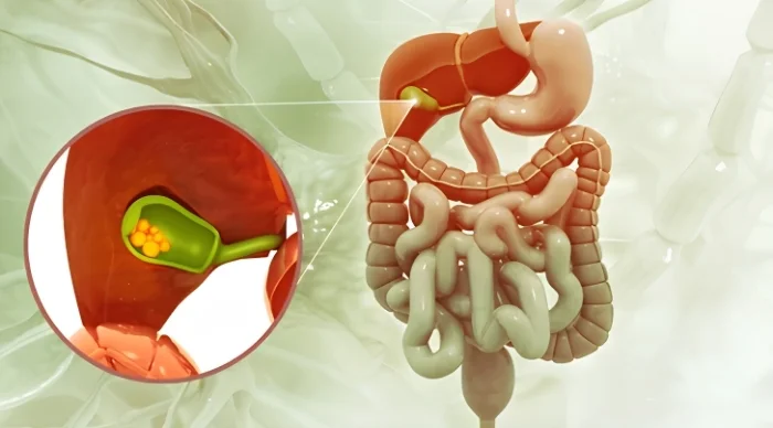 Gallstones