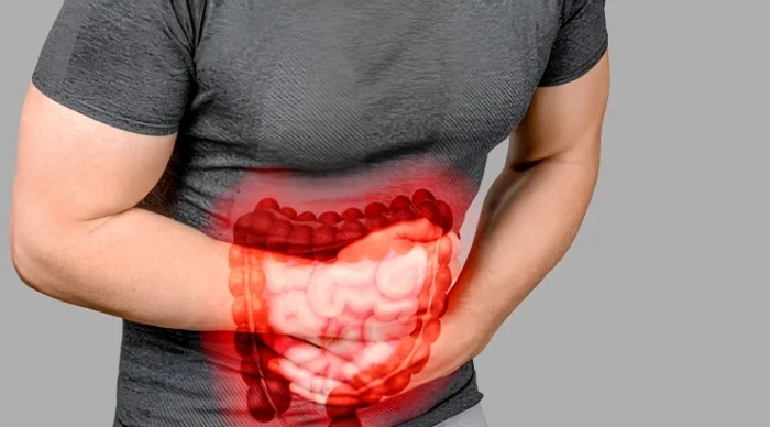 Irritable Bowel Syndrome (IBS)